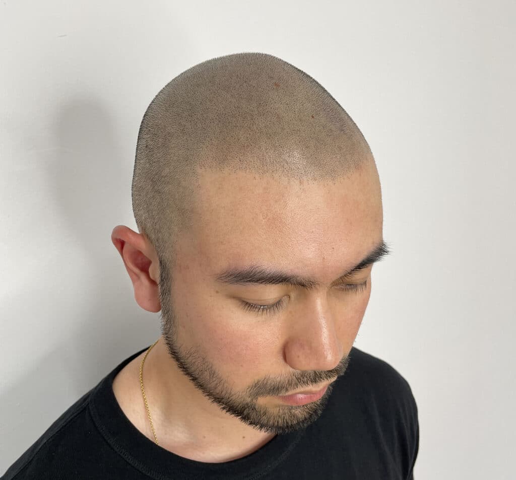 Innovatieve Oplossing: Micro Haar Pigmentatie voor Natuurlijke Haarillusie