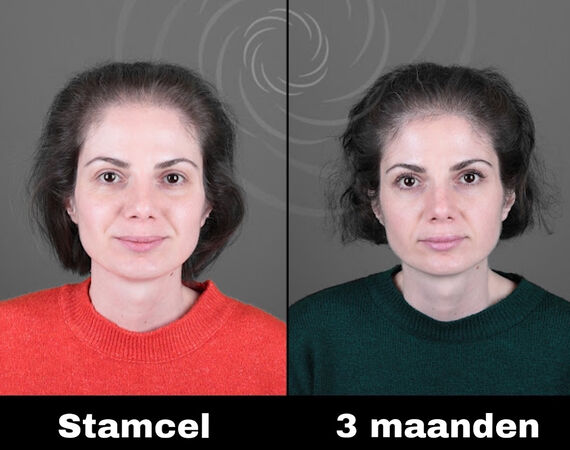 Revolutionaire Stamceltherapie voor Haaruitval: Een Nieuwe Hoop op Haargroei