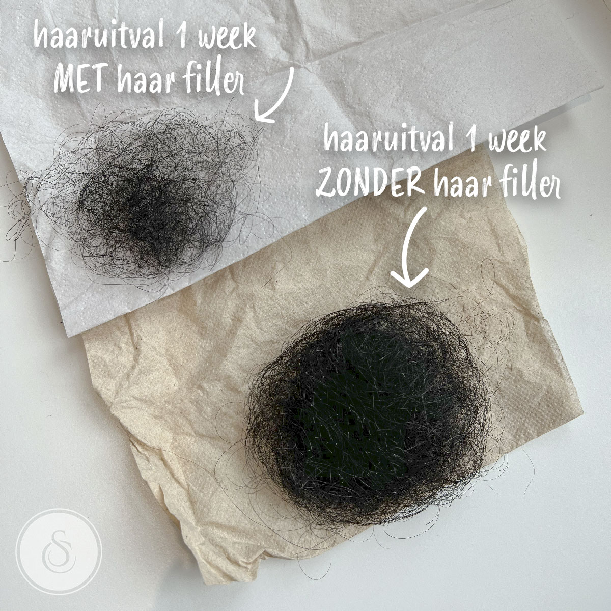 Dermatoloog voor haaruitval in Antwerpen: professionele hulp bij haarproblemen