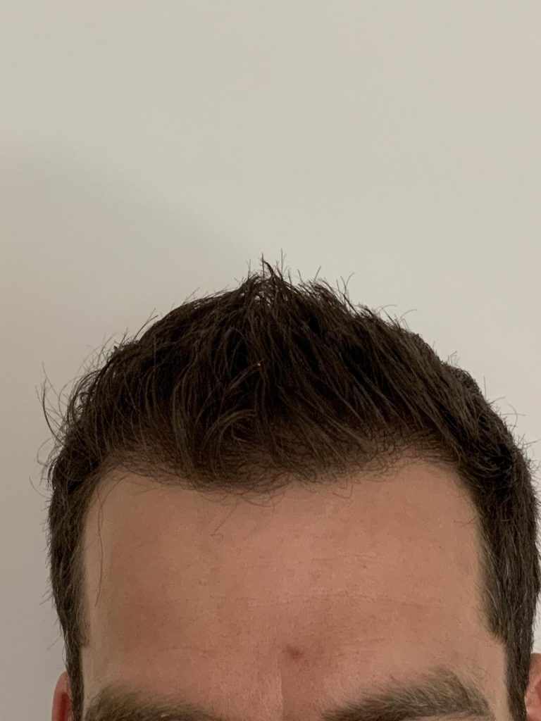 Alles wat je moet weten over haartransplantatie uitval: Feiten en Tips