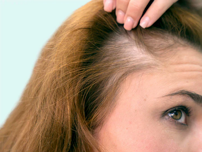 Haarverlies door stress: Oorzaken, Gevolgen en Oplossingen