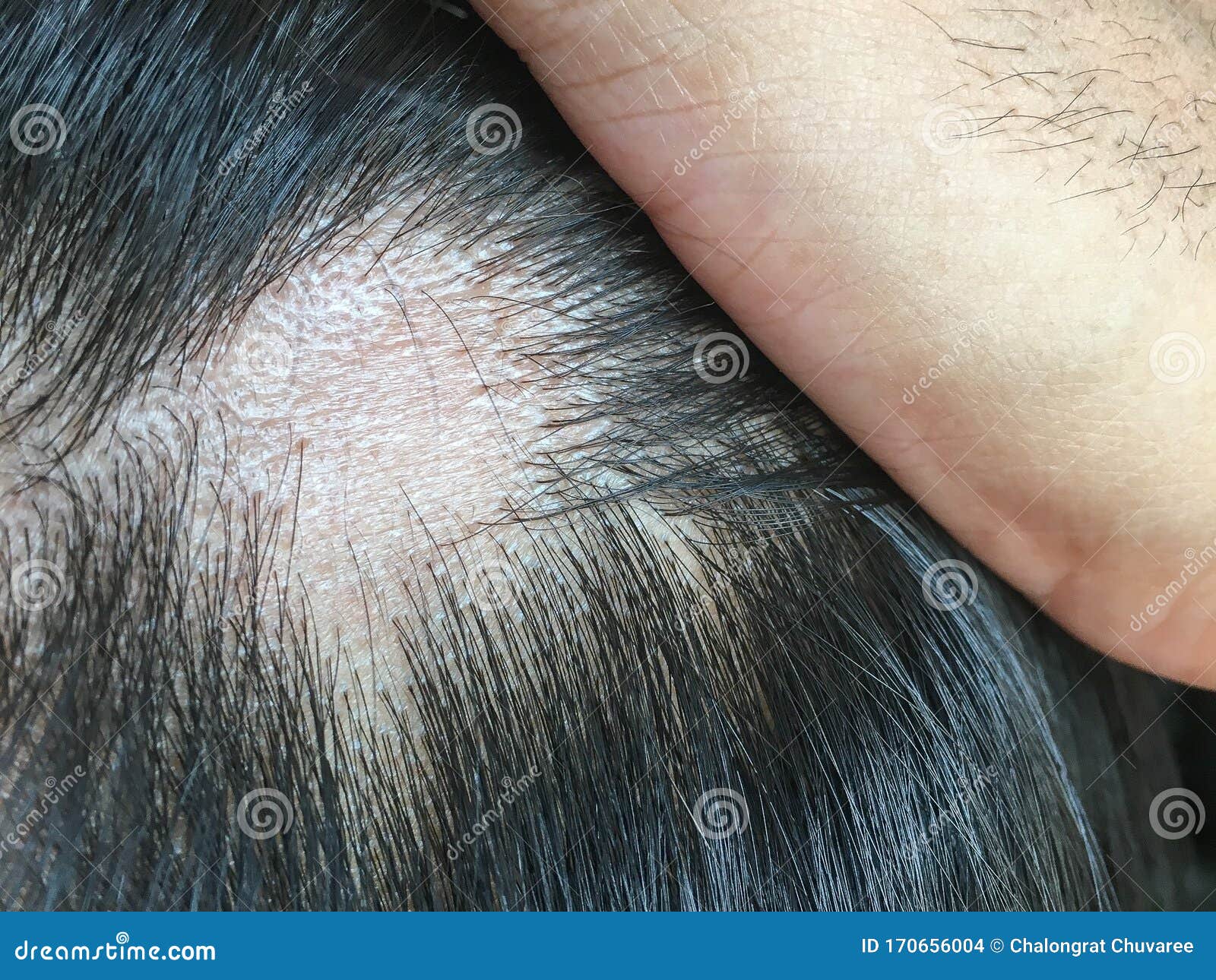 De Impact van Stress op Haarverlies bij Vrouwen: Een Belangrijke Zorg