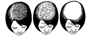 Haarverlies bij vrouwen tijdens de overgang: Oorzaken en Behandelingen