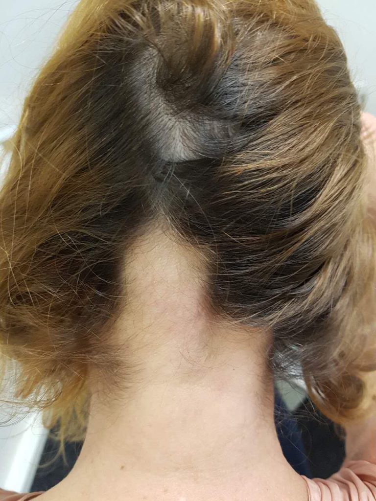 Behandeling van kale plekken op het hoofd bij vrouwen