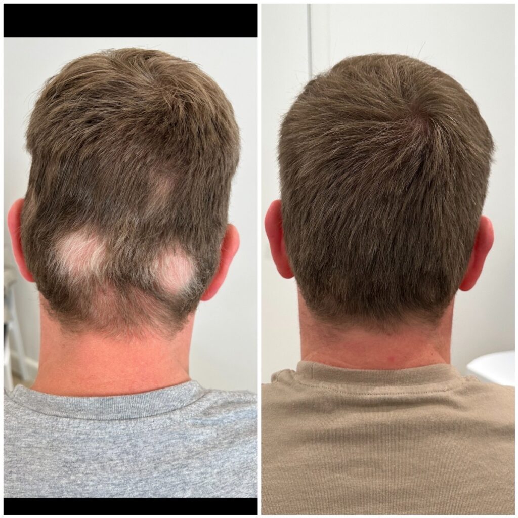 Belangrijkste redenen voor haaruitval bij mannen: Een diepgaande analyse