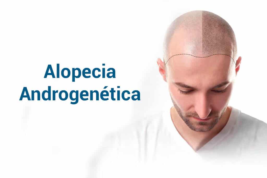 Alles over Alopecia Androgenetica: Oorzaken, Symptomen en Behandelingen