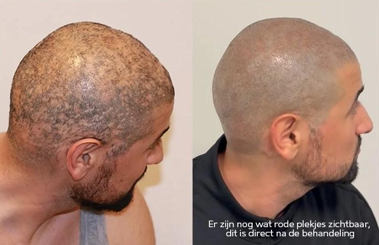 Nieuwe Behandelingen voor Alopecia Areata in 2020