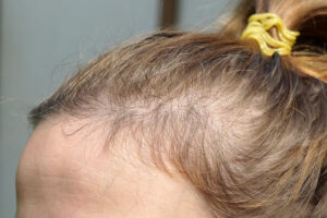 Behandeling van Alopecia Diffusa: Effectieve Oplossingen voor Haarverlies