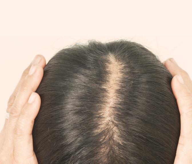 Dermatoloog voor haaruitval bij vrouwen: professionele hulp voor gezonde haargroei