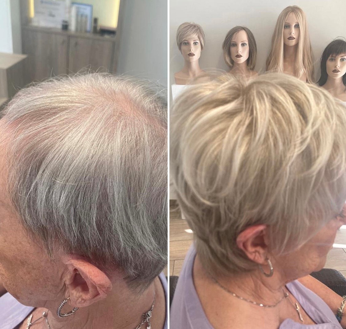 Dun haar aan de voorkant bij vrouwen: Oorzaken en oplossingen