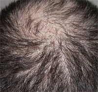 De Rol van Erfelijkheid bij Kaalheid: Een Diepgaande Verkenning