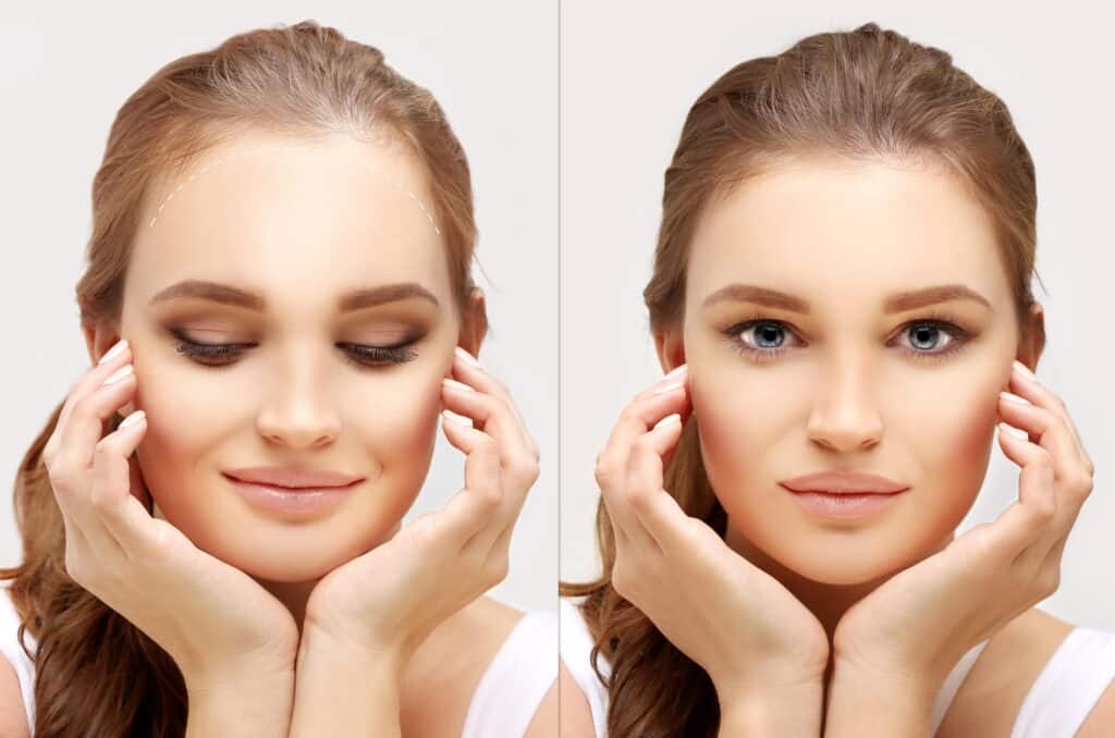 Behandeling van Frontale Fibroserende Alopecia: Opties en Advies