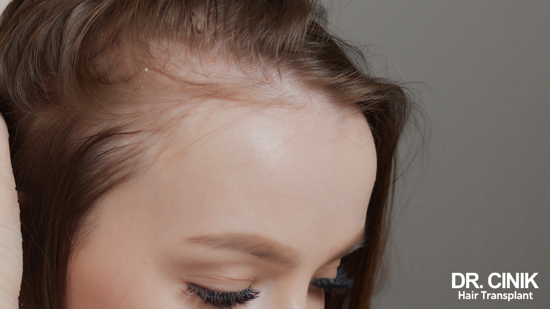 Frontale Fibroserende Alopecia Specialist: Expertise in Haarverliesbehandeling