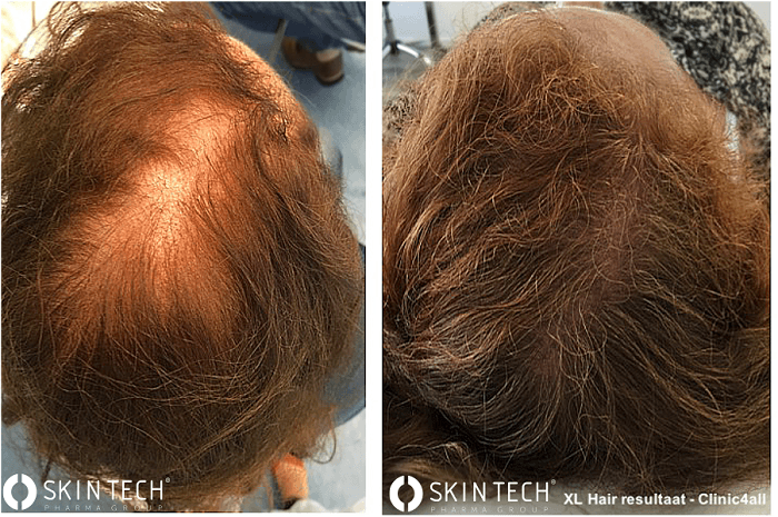 Natuurlijk Haargroei Stimuleren bij Vrouwen: Tips en Advies