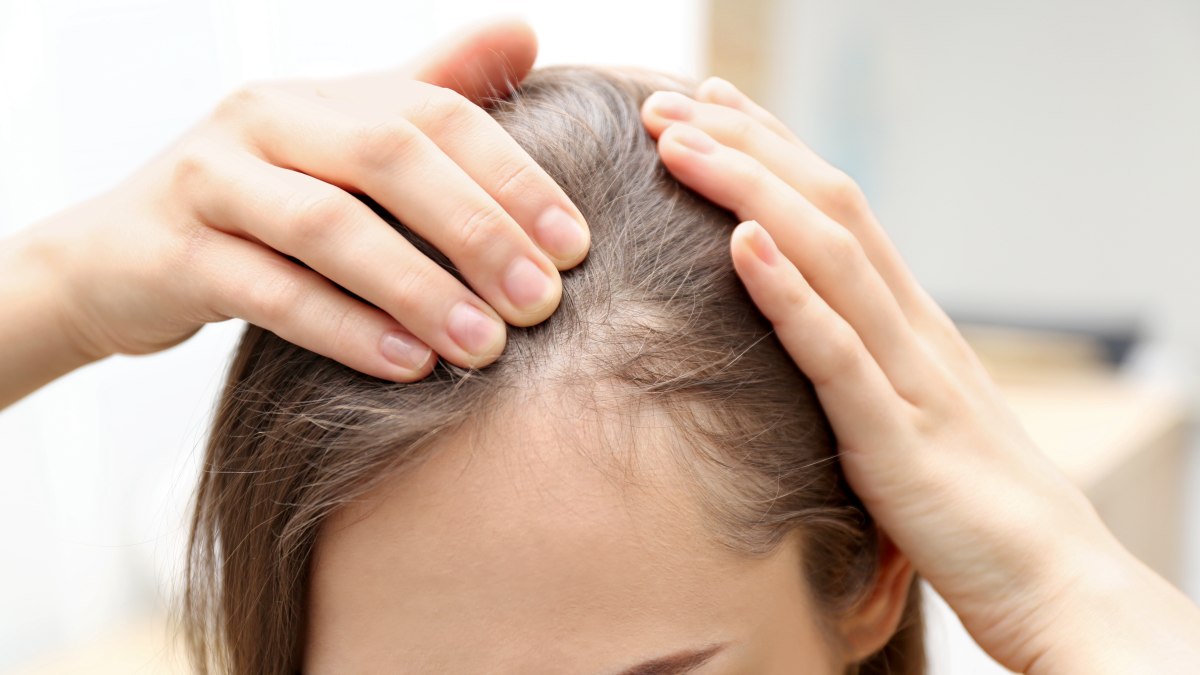 Behandeling van Kale Plekken op het Hoofd bij Vrouwen