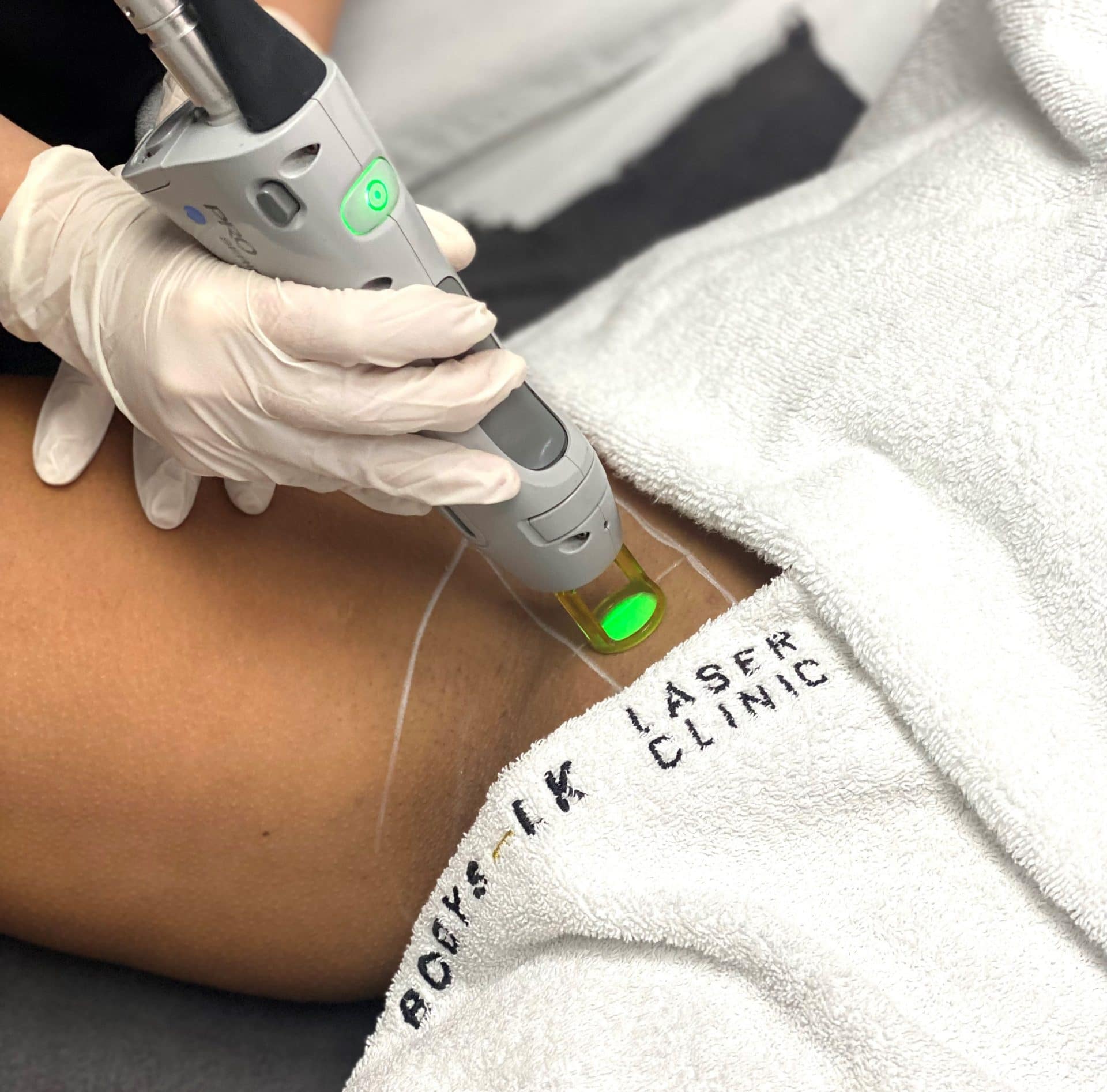 Stralend haarvrij met veilig laseren voor elke huidskleur!