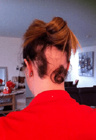 De Oorzaak van Alopecia Areata: Wat U Moet Weten