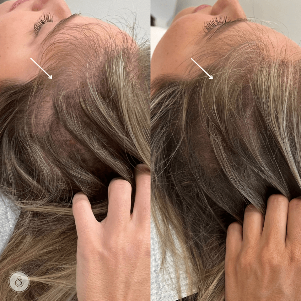 Oplossing voor Dunner Wordend Haar bij Vrouwen: Tips en Advies