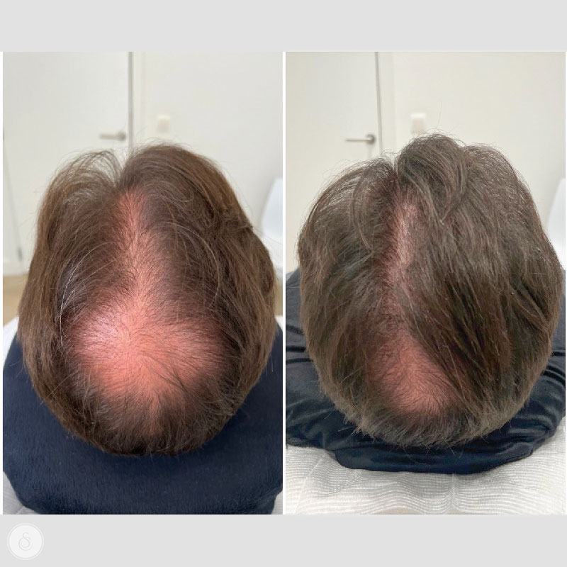 Oorzaken van haaruitval bij mannen: Een diepgaande analyse