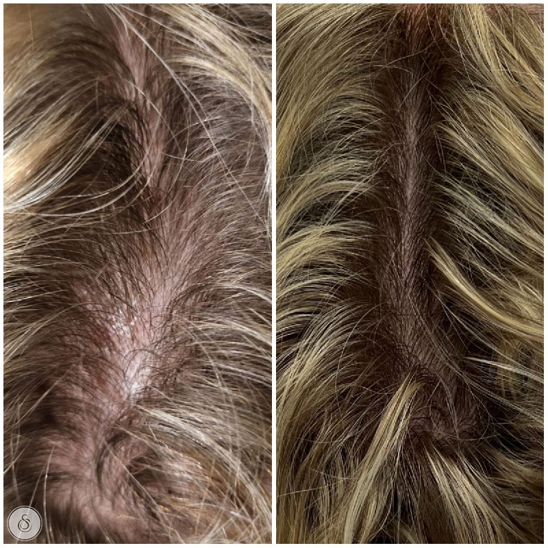 Belangrijkste redenen voor haaruitval bij vrouwen: Ontdek de oorzaken en oplossingen