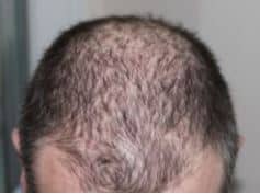 Kan te veel vitamine B leiden tot haaruitval? Ontdek de feiten.