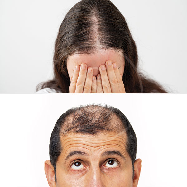 Alles wat je moet weten over telogeen haarverlies: oorzaken en behandelingen