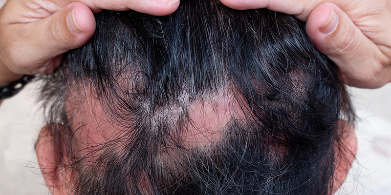 Verrijkende Alopecia Areata Ervaringen: Een Bron van Steun en Inspiratie