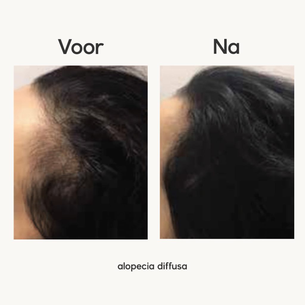 Alopecia: een veelvoorkomende haaruitval aandoening
