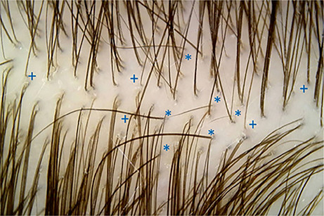 Alles over diffuus haarverlies: Oorzaken, Behandelingen en Tips