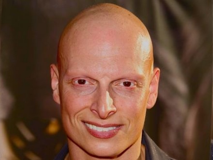 Kan Alopecia Areata Vanzelf Overgaan?