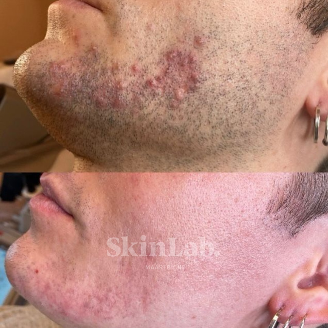 Behandeling van haaruitval: Haar laseren voor mannen