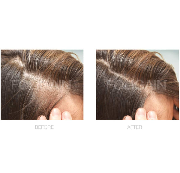 Alles over haargroei met minoxidil: Effectiviteit en gebruikstips