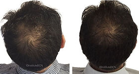 Behandelingen om Haargroei te Stimuleren: Effectieve Opties voor Gezonder Haar