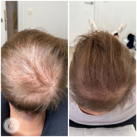 Hoe kaalheid effectief tegengaan: Tips en advies voor gezond haar