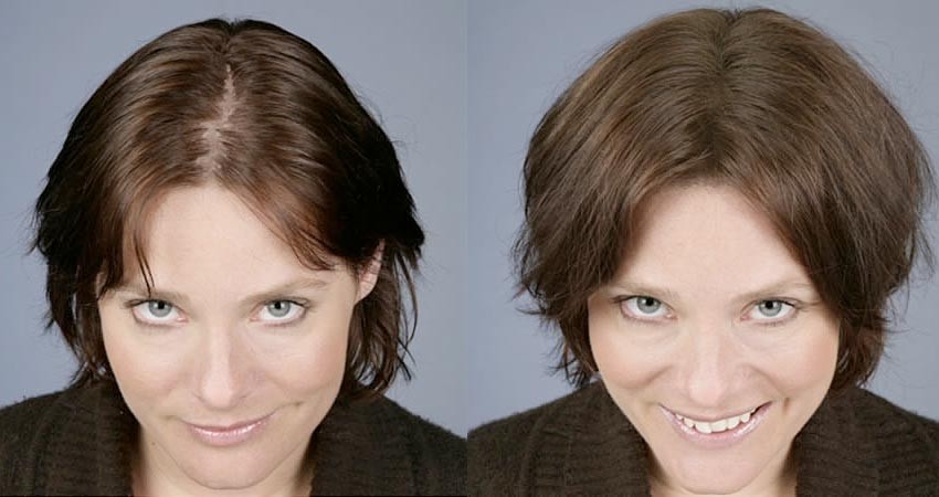 Help, Ik Word Kaal: Advies voor Vrouwen met Haaruitval