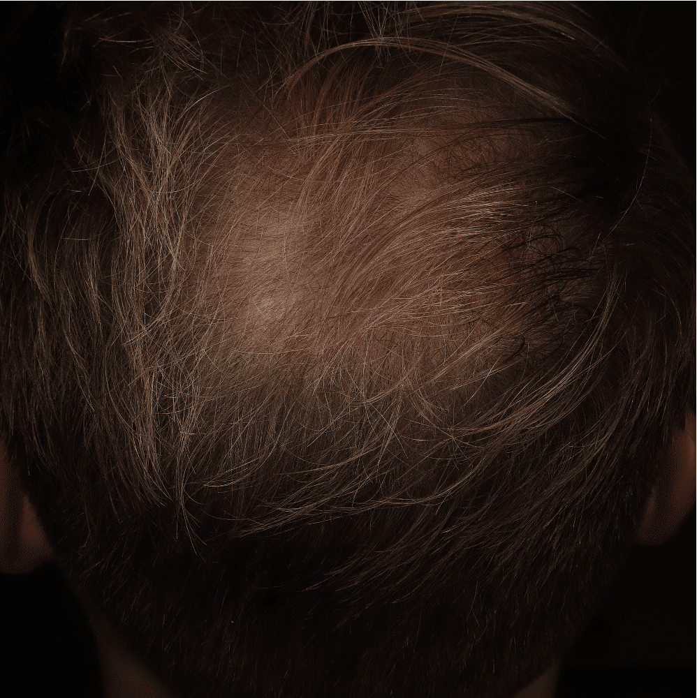 Symptomen van Alopecia Androgenetica bij Vrouwen: Wat u moet weten