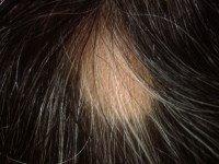 Herken de Symptomen van Alopecia: Signaleer Haaruitval Vroegtijdig