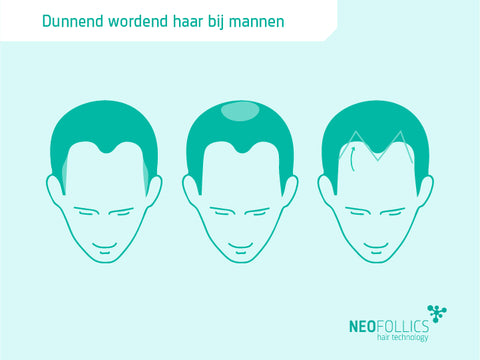 Bij Vrouwen Wordt Het Haar Midden Op Het Hoofd Dunner: Een Veelvoorkomend Probleem