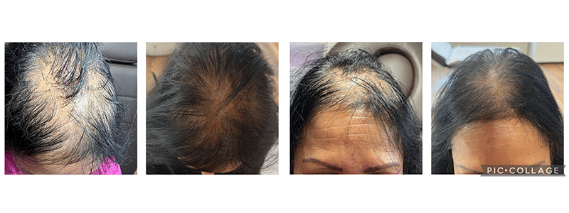 Effectieve Methoden om Kaalheid te Behandelen: Een Gids voor Haarverlies