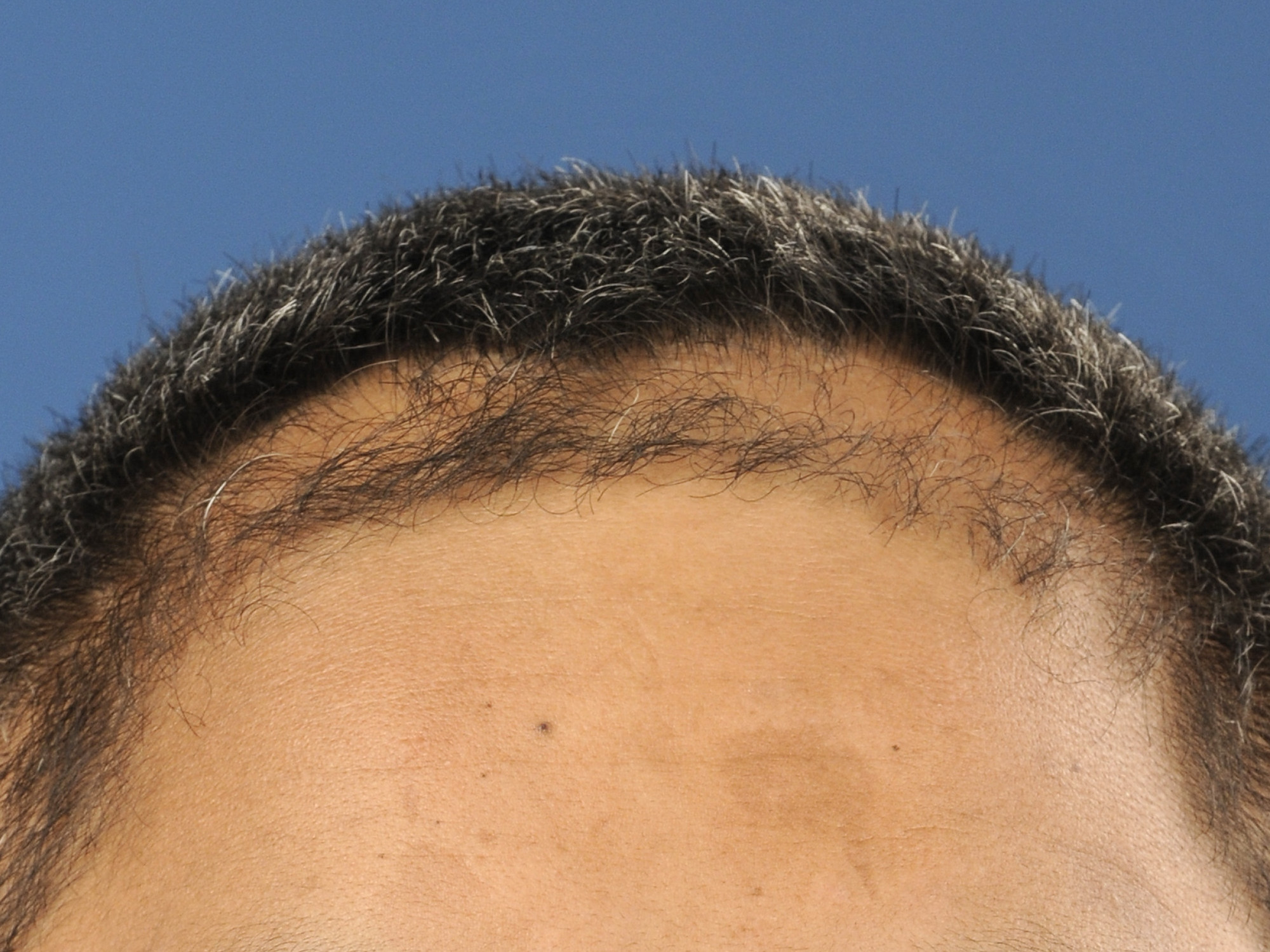 Haar Verven bij Alopecia Androgenetica: Tips en Advies