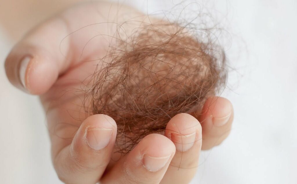 Effecten van Alopecia Corona op Haaruitval: Wat u moet weten