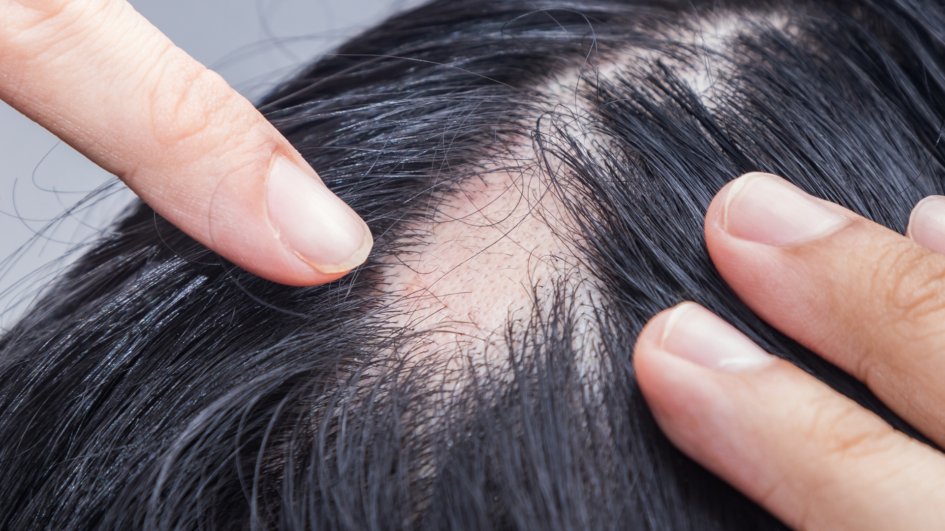 Behandeling van Alopecia: Effectieve Medicijnen voor Haaruitval