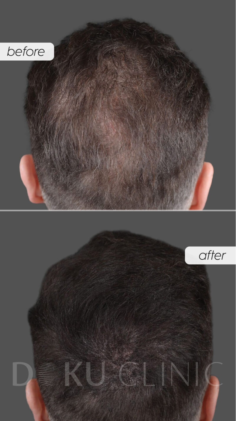 Effectiviteit van Dermaroller bij Alopecia Androgenetica: Een Nieuwe Behandelingsoptie