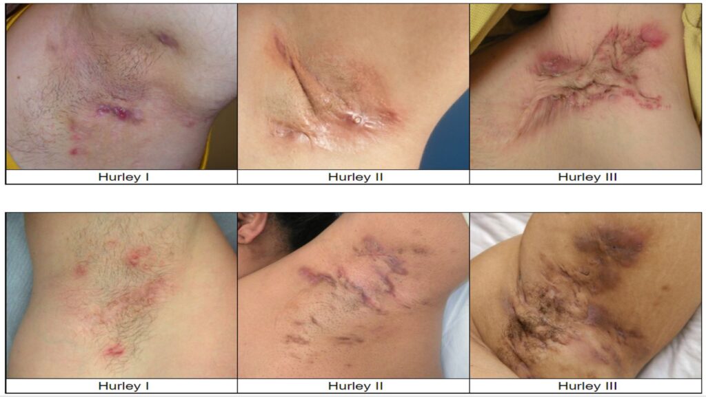 Stimuleer Haargroei Na Laserbehandeling: Ontdek de Effectieve Oplossing voor Haaruitval