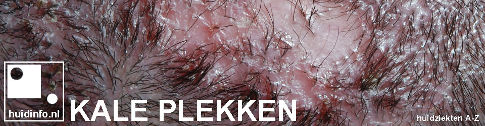 Alles over de haarziekte kaal: Oorzaken, Symptomen en Behandeling