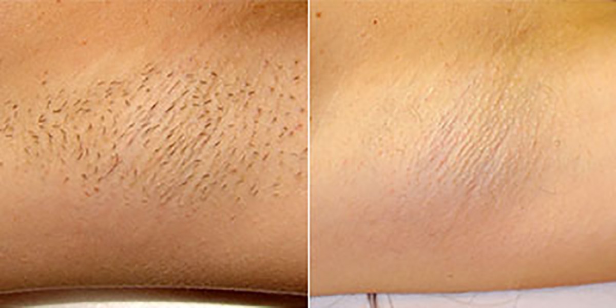Revolutionaire Laser Definitief Ontharen: Voor Een Langdurig Gladde Huid
