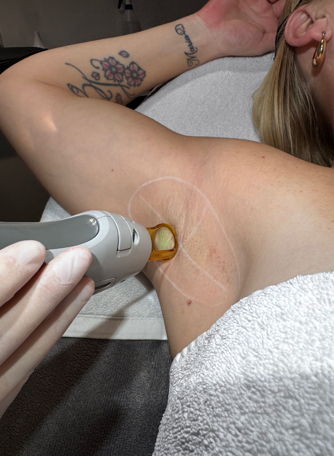 Ontdek de Voordelen van Laser Ontharen voor een Langdurig Glad Resultaat