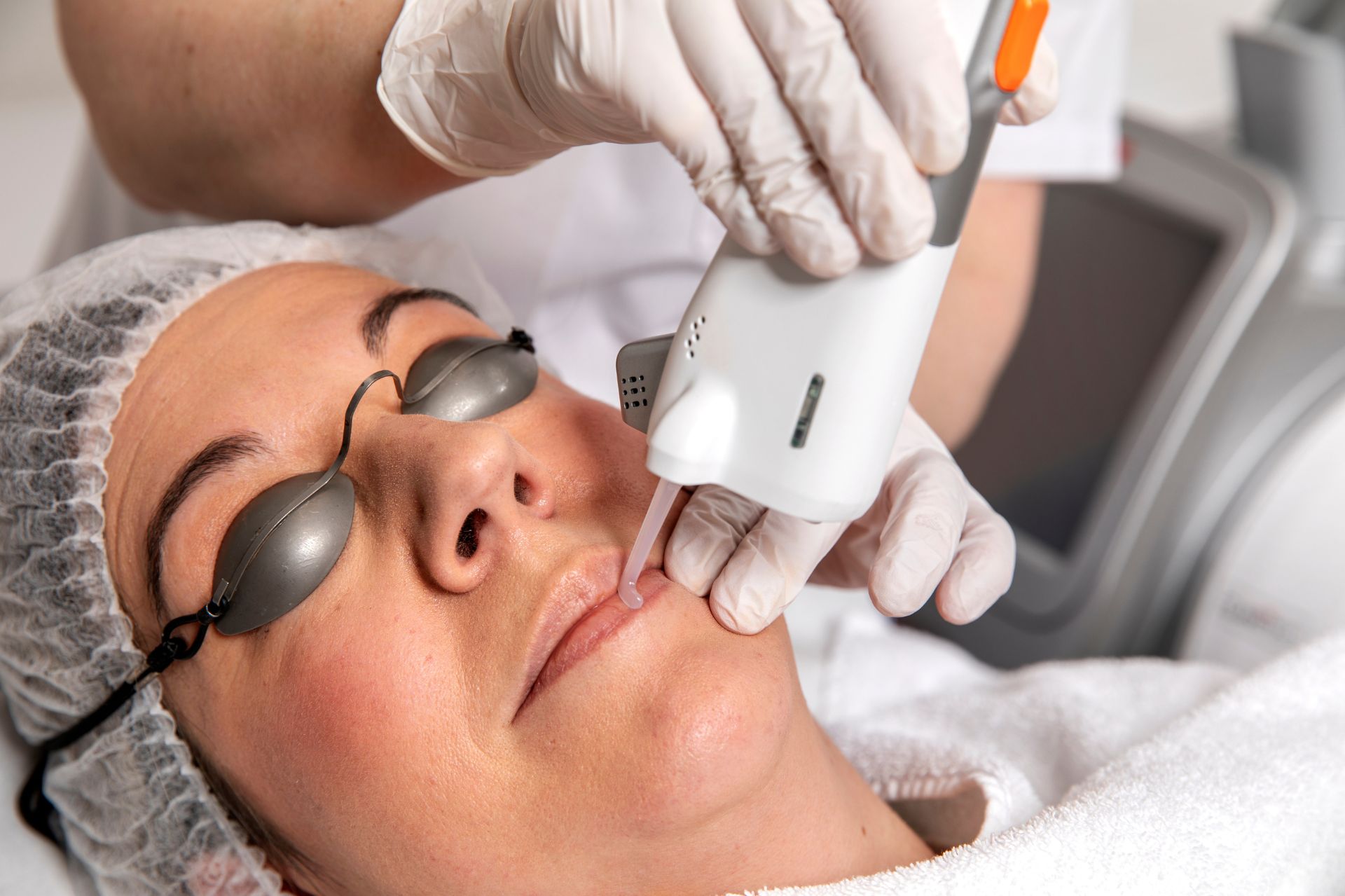 Effectieve Oplossing voor Gezichtsbeharing: Lasertechnologie in de Spotlight