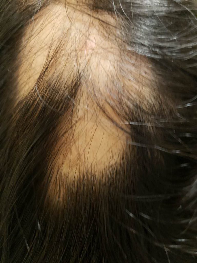 Innovatieve Nieuwe Behandeling voor Alopecia Areata