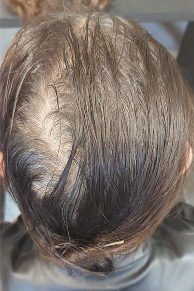 De Rol van een Specialist in de Behandeling van Alopecia
